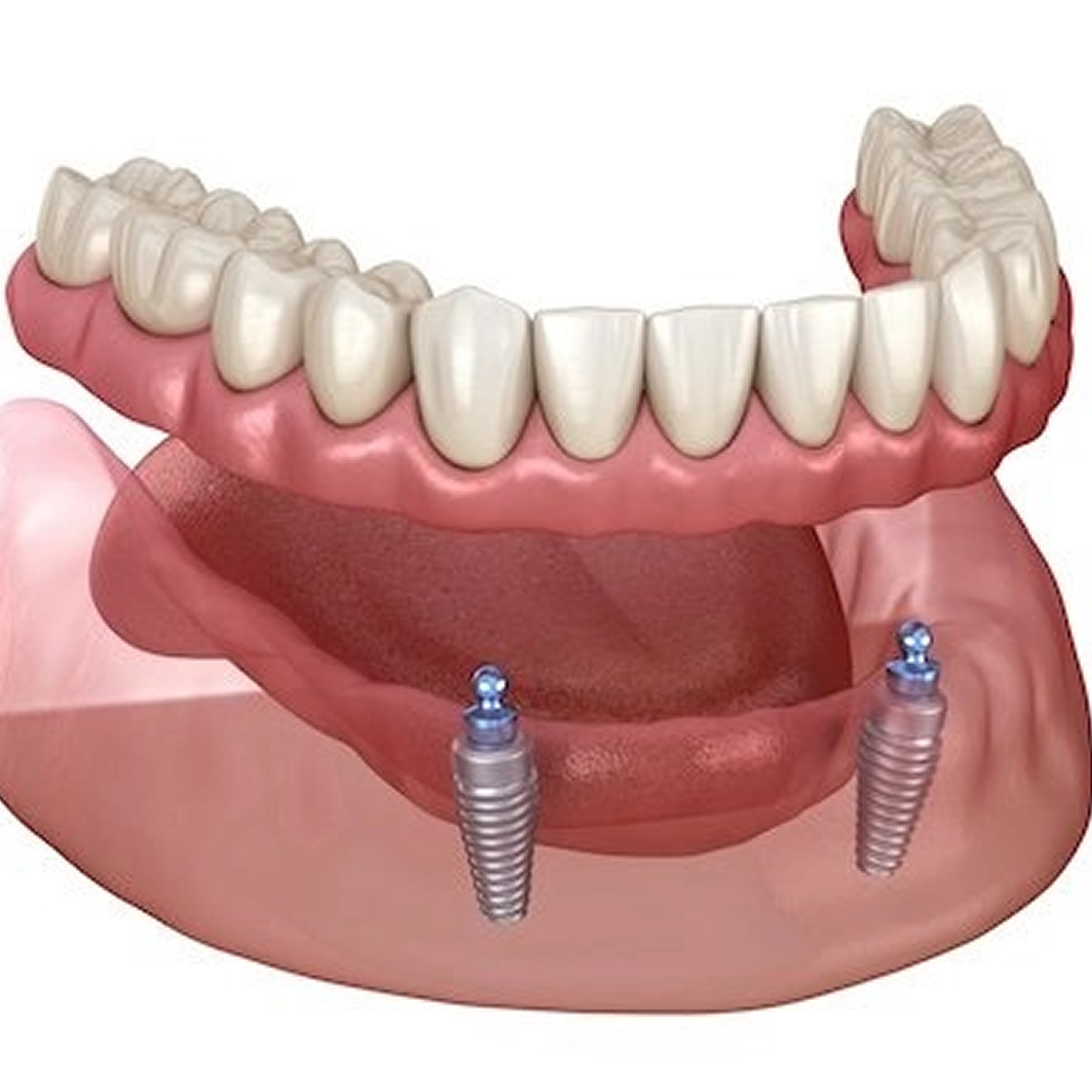 snap on denture location